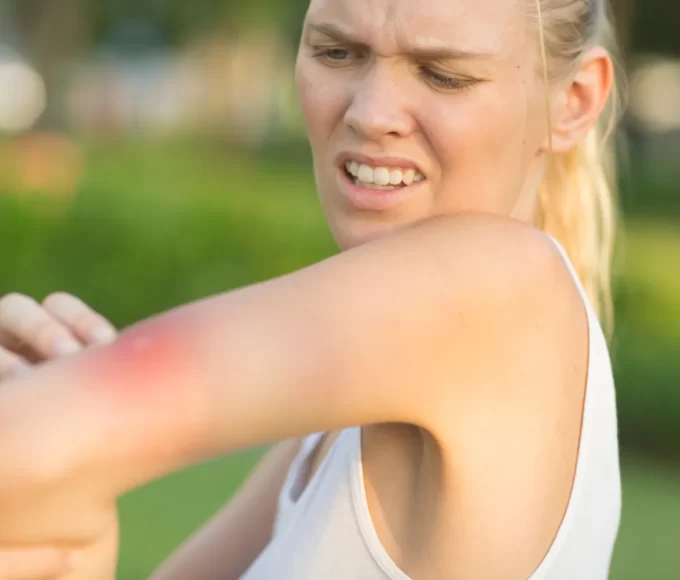 astuces piqures moustiques