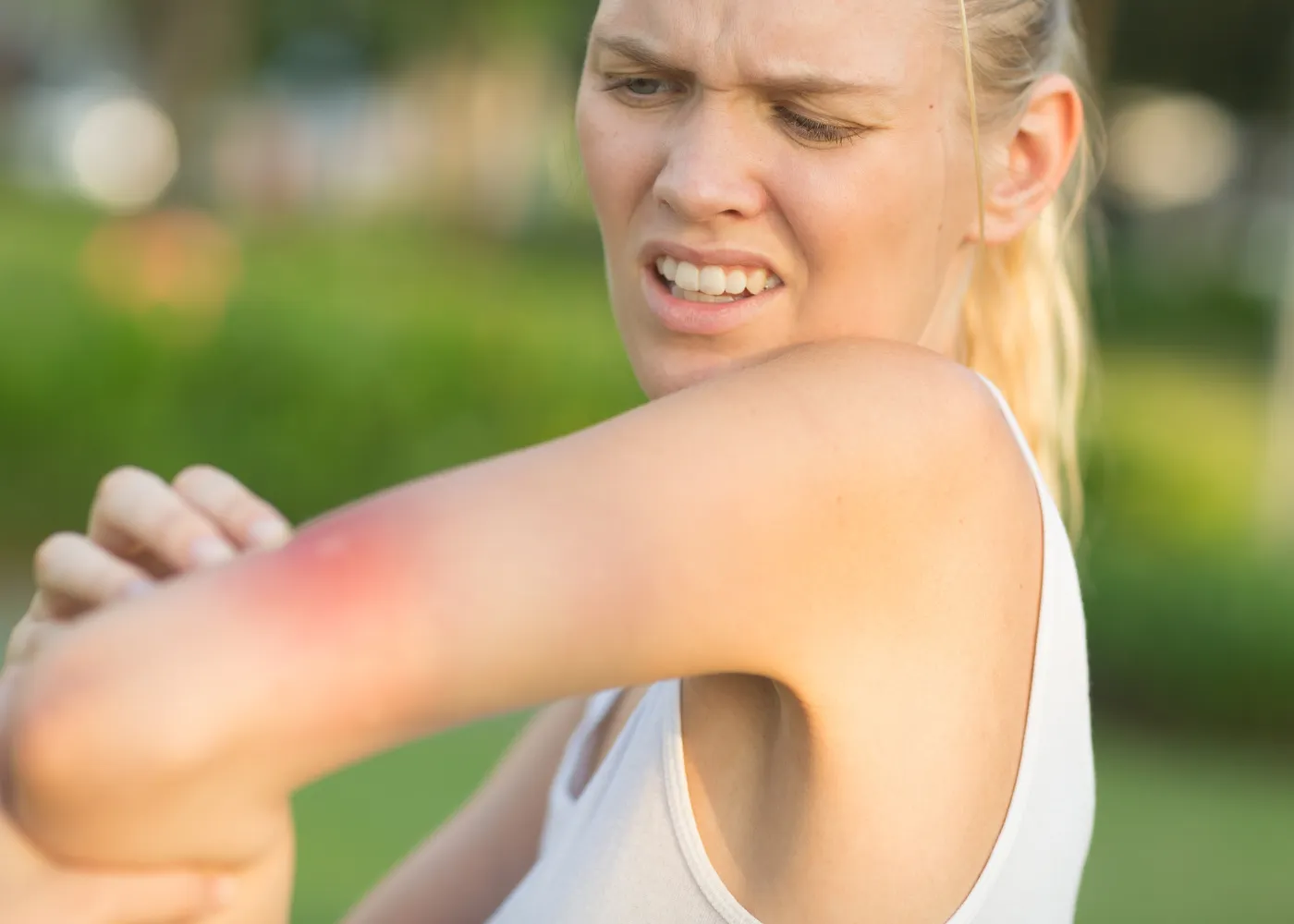 astuces piqures moustiques